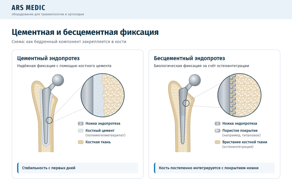 Схема цементной и бесцементной фиксации ножки эндопротеза в бедренной кости