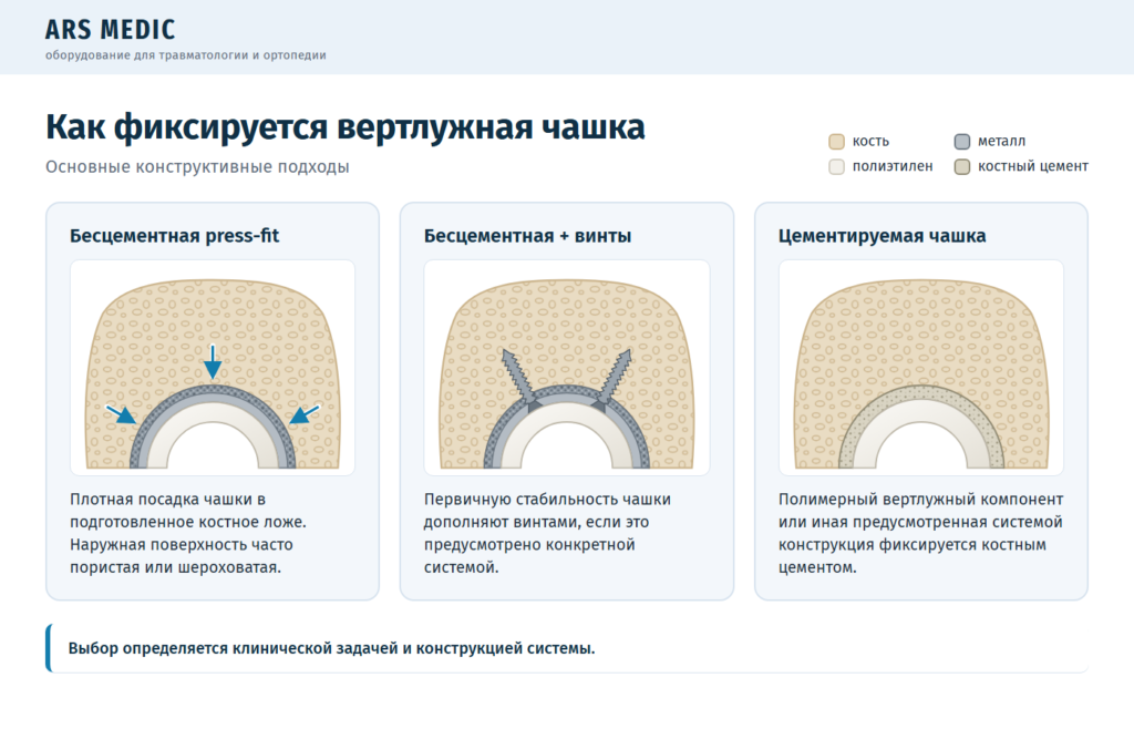 Способы фиксации вертлужной чашки: бесцементная press-fit, с винтами и на костном цементе