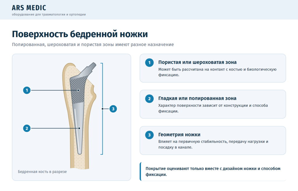 Ножка эндопротеза в бедренной кости: пористая зона, полированная зона и геометрия