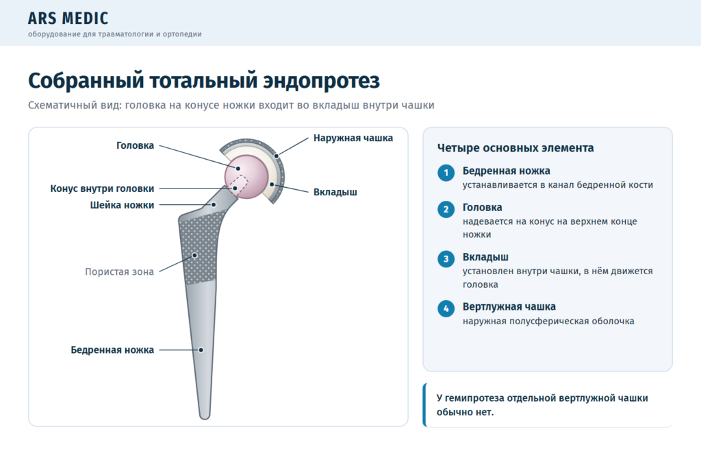 Схема собранного тотального эндопротеза тазобедренного сустава: ножка, головка, вкладыш и чашка
