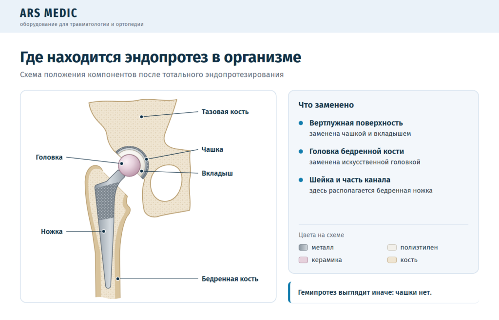 Схема положения эндопротеза в тазовой и бедренной кости после тотального эндопротезирования